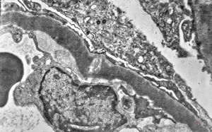 M,29y. | type II membranoproliferative glomerulonephritis (dense deposit disease)